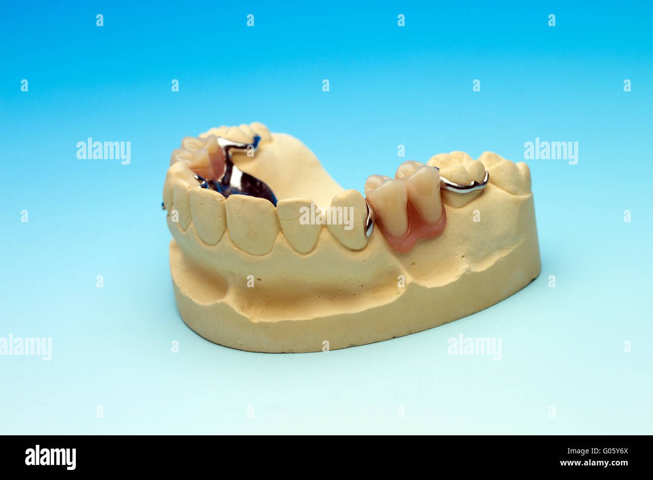 Dental bridge with 2 teeth Stock Photo