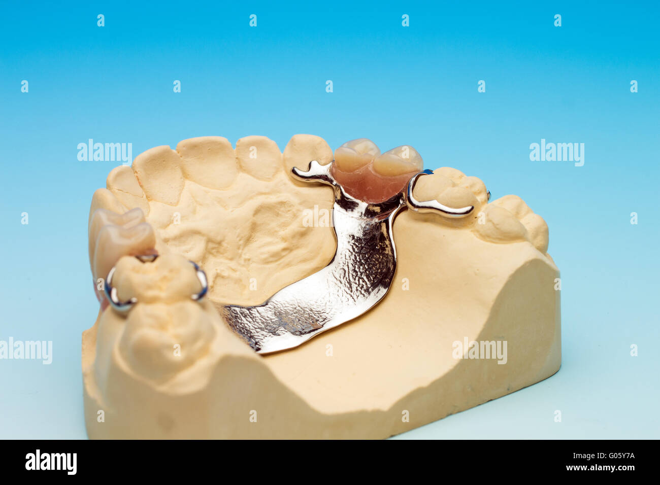 Maxillary dental bridge Stock Photo