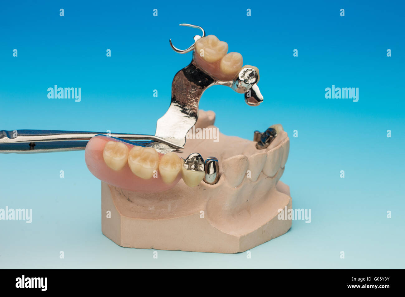 Tweezer fits a dental bridge Stock Photo