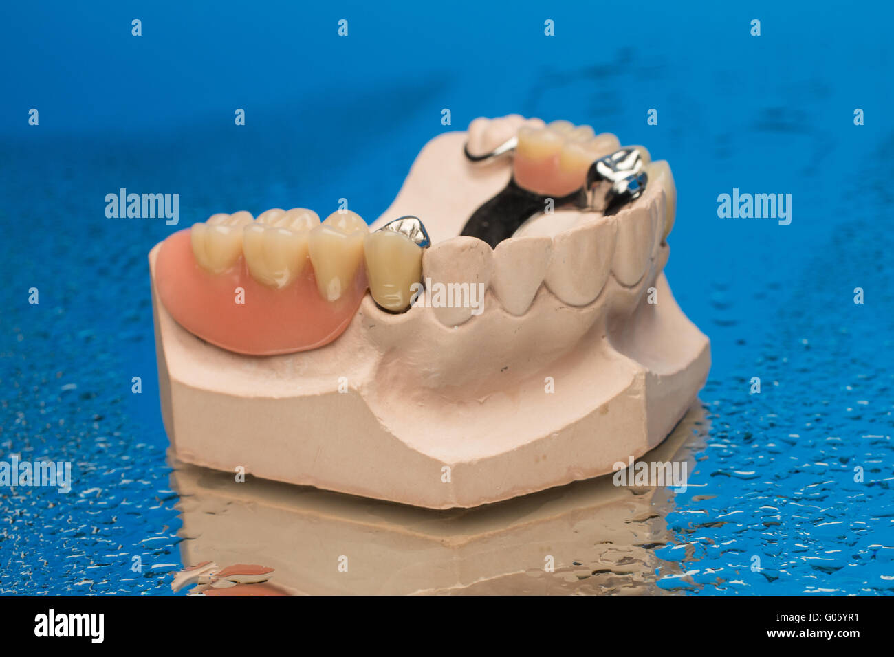 CoCr denture with bridge Stock Photo