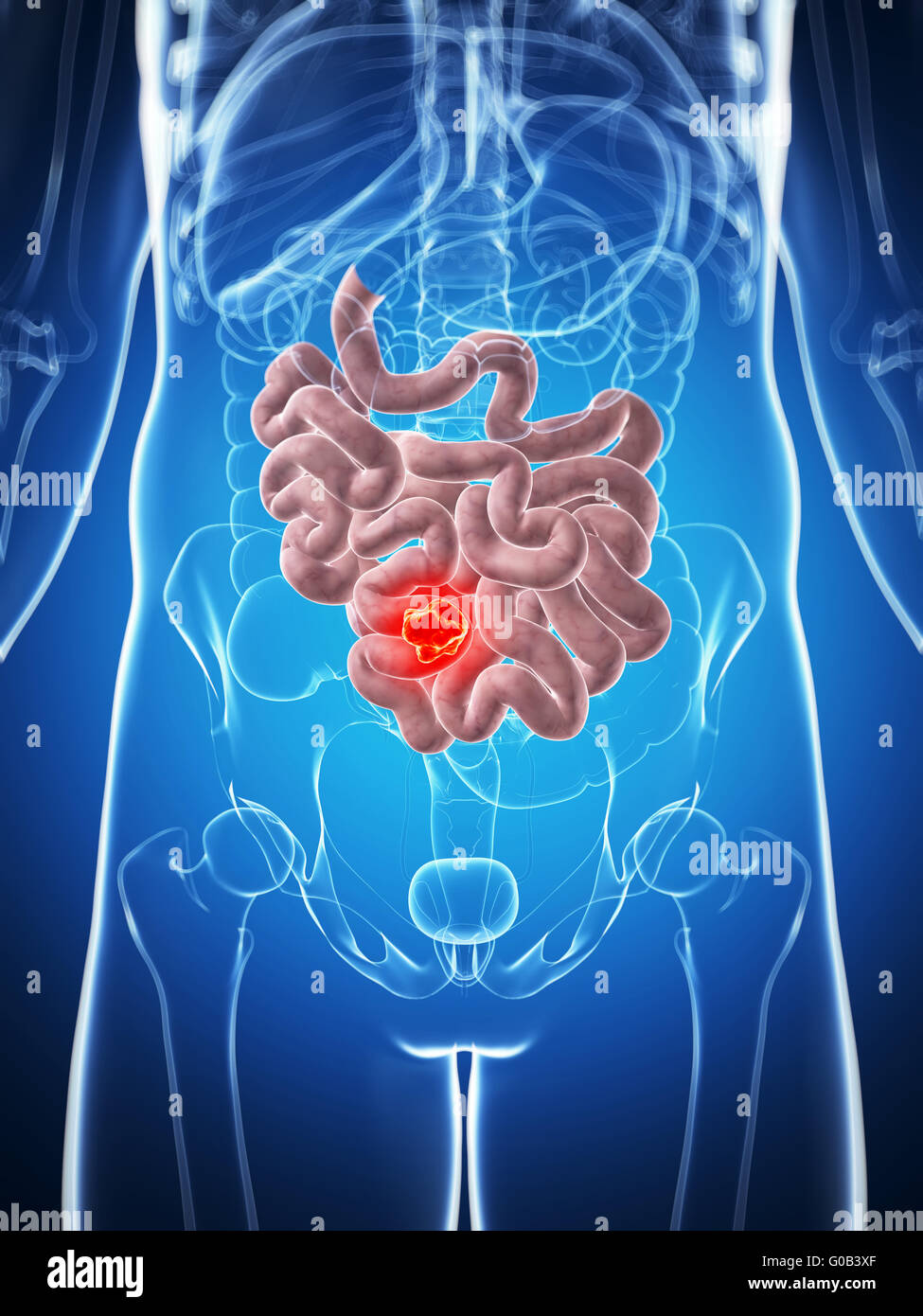 3d rendered illustration of the male small intestine - cancer Stock ...