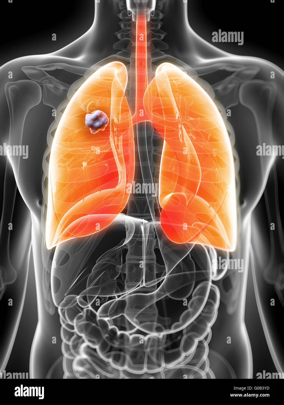 3d rendered illustration of the male lung - cancer Stock Photo