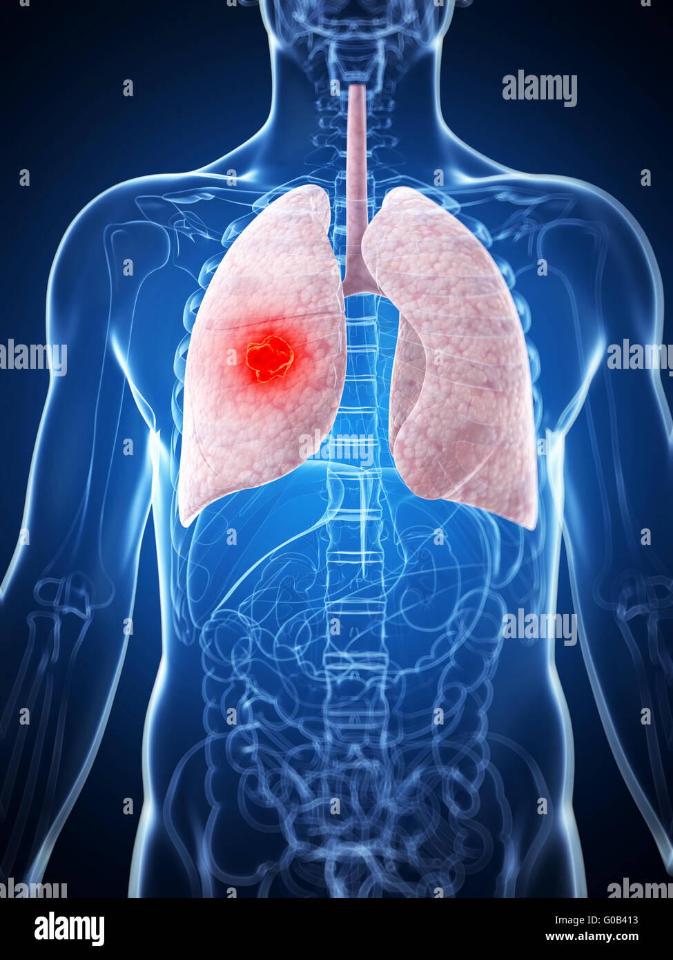 3d rendered illustration of the male lung - cancer Stock Photo