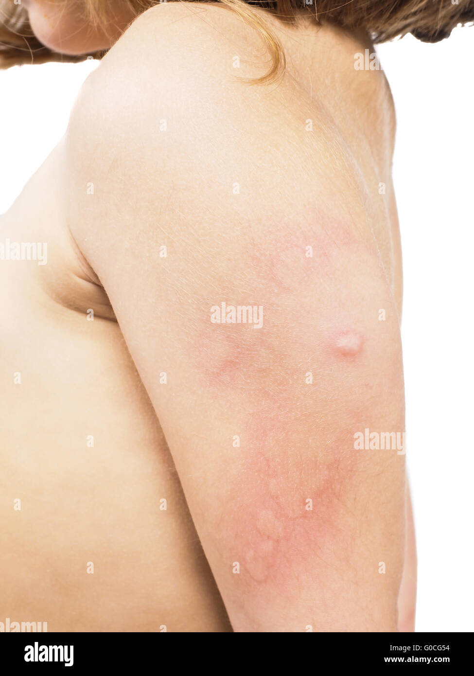 Red colored rash on skin of child Stock Photo