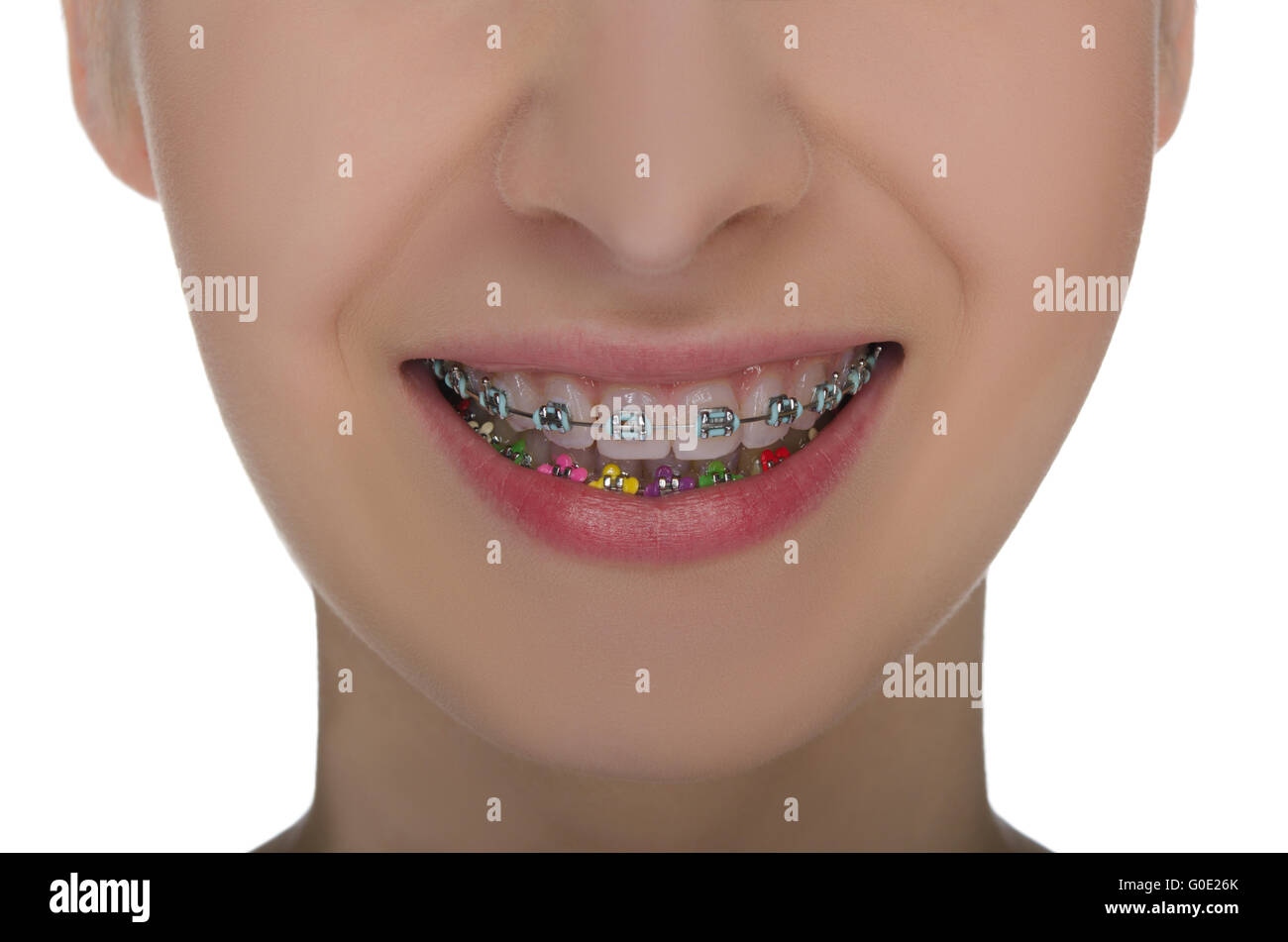 Mouth with braces hires stock photography and images Alamy