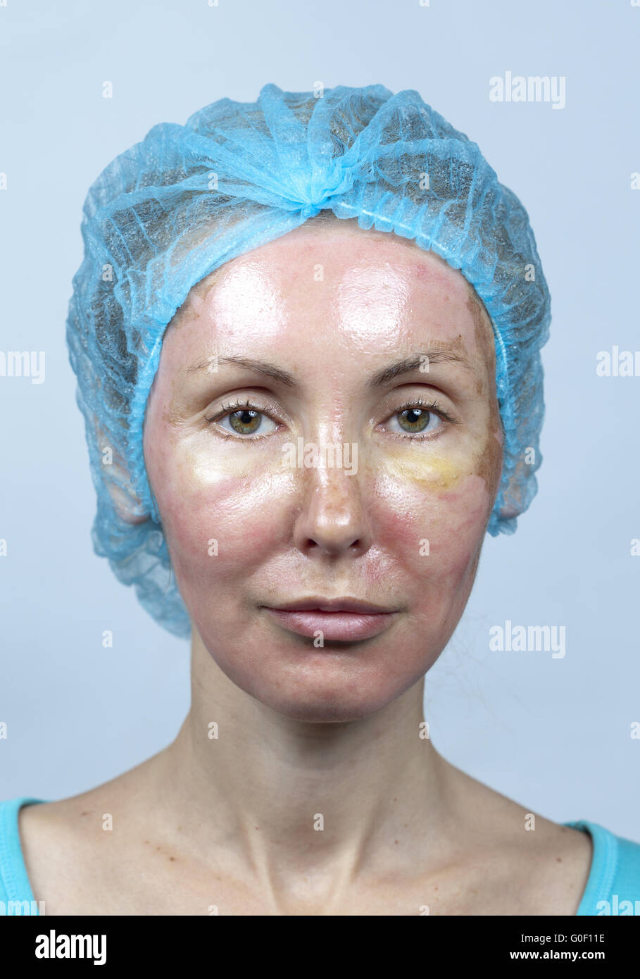 Cosmetology.Skin after a deep chemical peeling Stock Photo