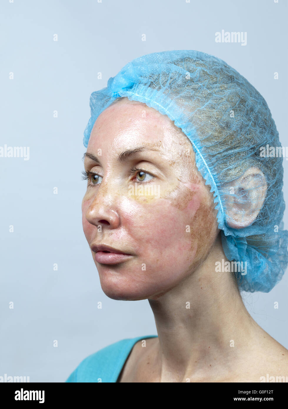 Cosmetology. New skin after a chemical peeling Stock Photo Alamy