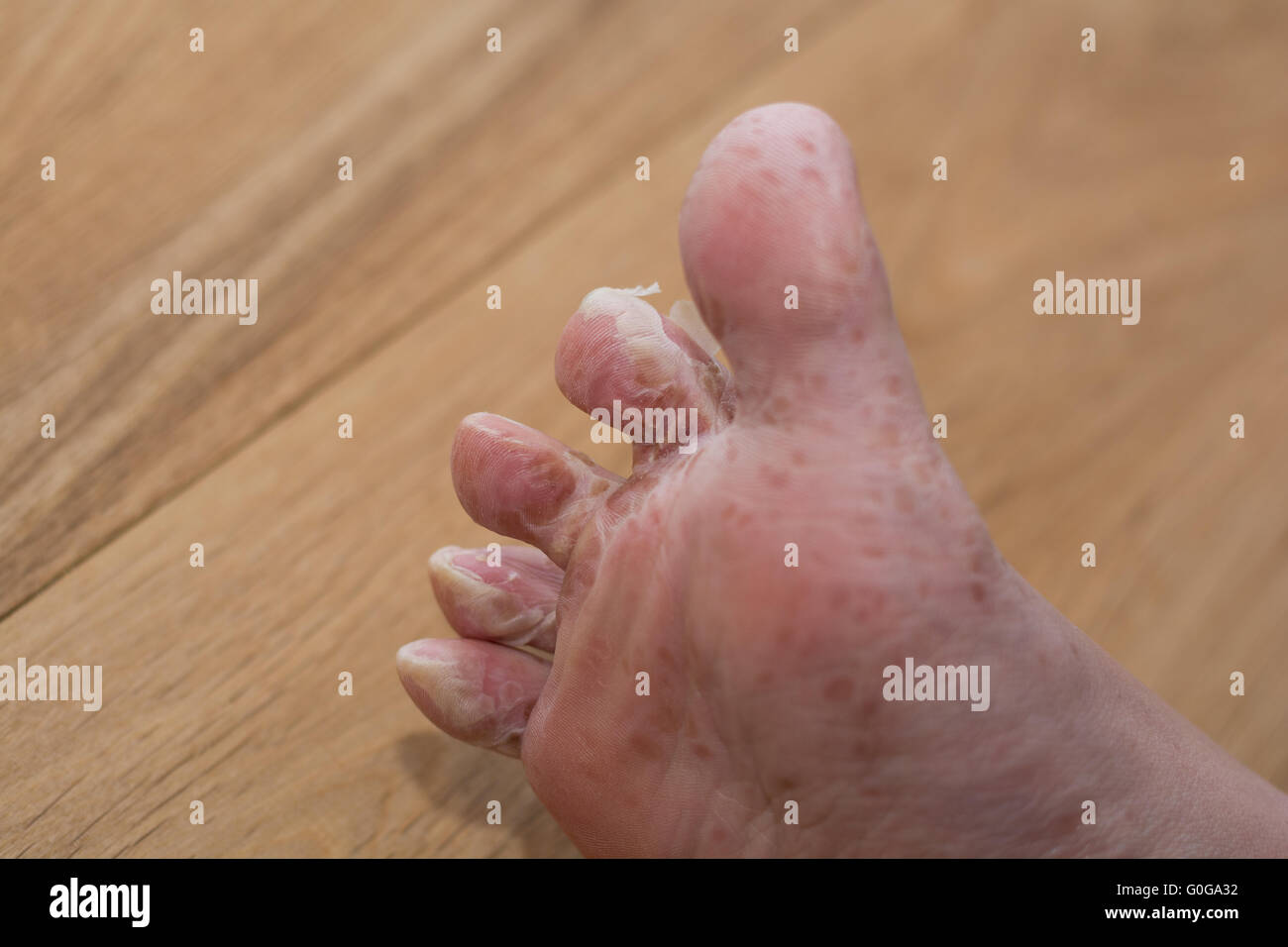 Foot molts after viral skin disease - close-up Stock Photo