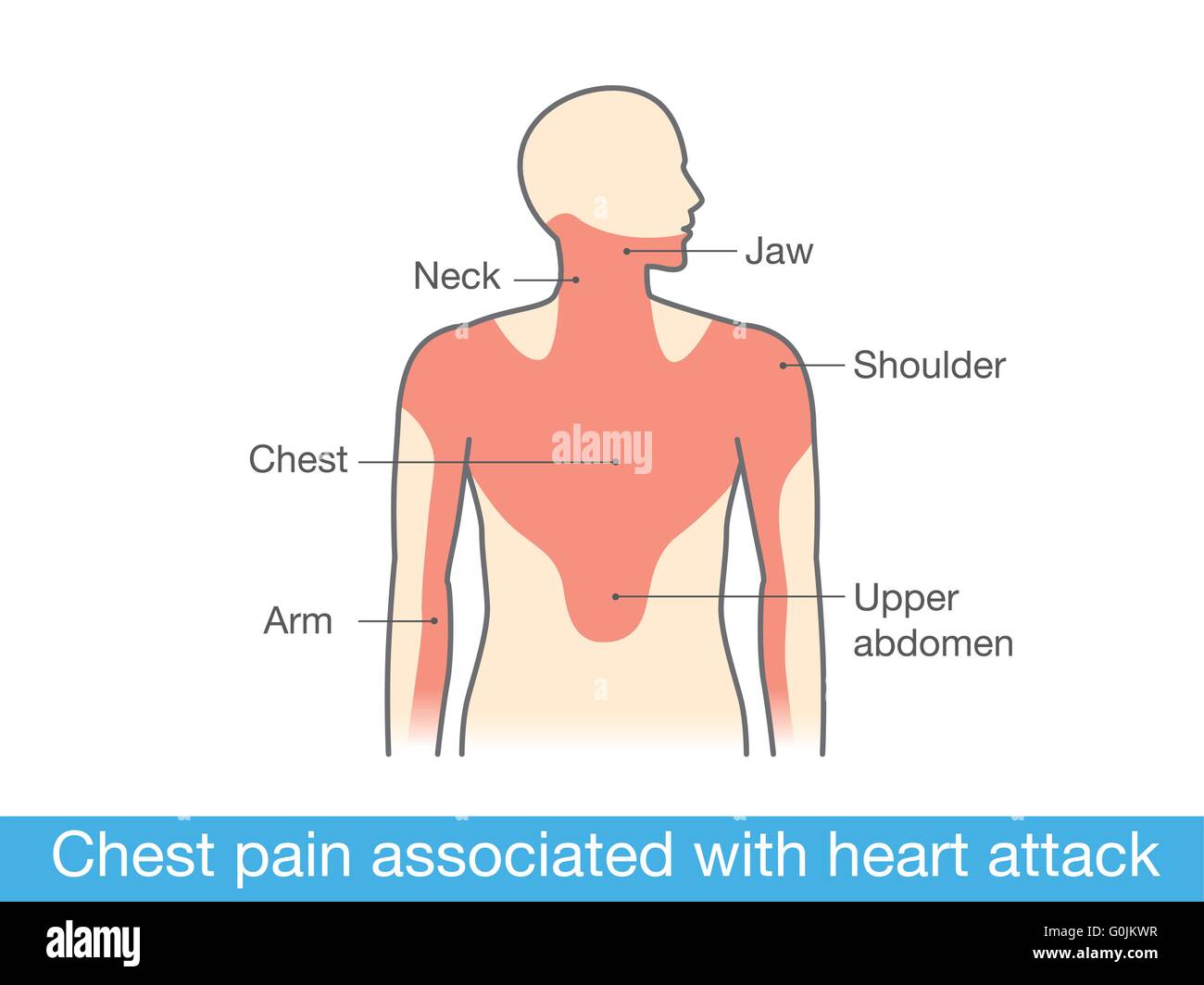 What Does Chest Pain Feel Like During Heart Attack