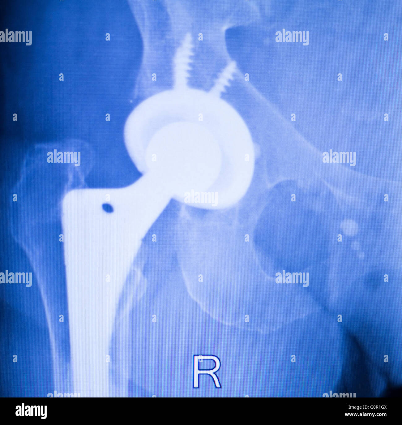 Hip joint implant xray scan test results for adult patient showing