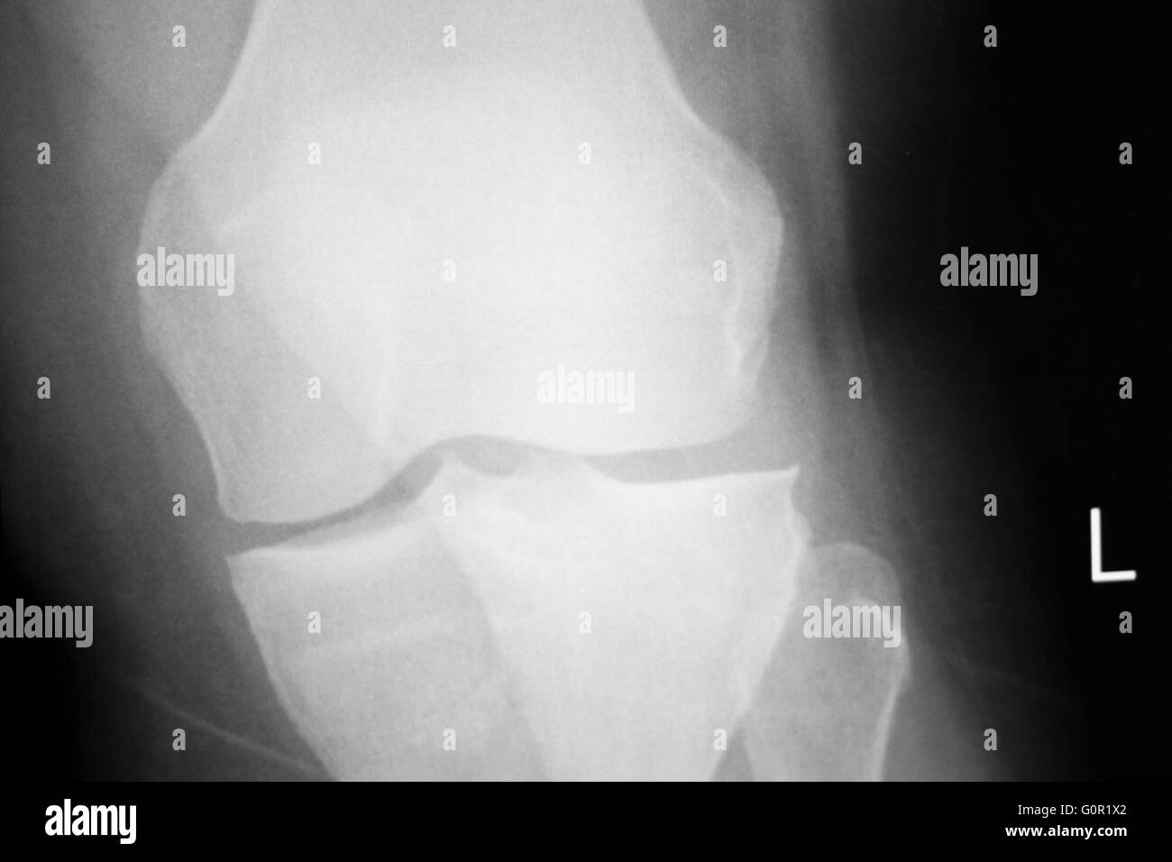 Knee and meniscus injury medical x-ray test scan result for adult patient. Stock Photo