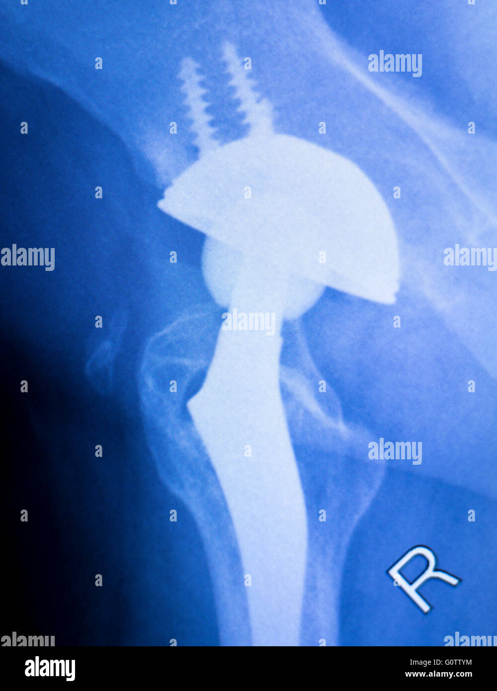 Hip joint implant xray scan test results for adult patient showing