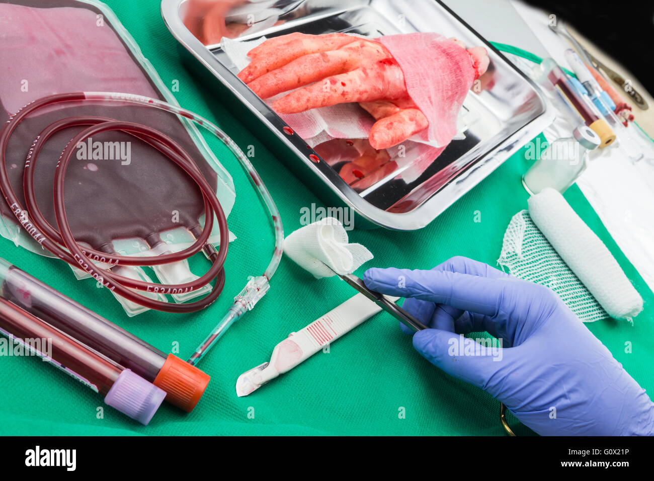 Unit of concentrate of red blood cells, transplantation of upper limb in a surgery room Stock Photo