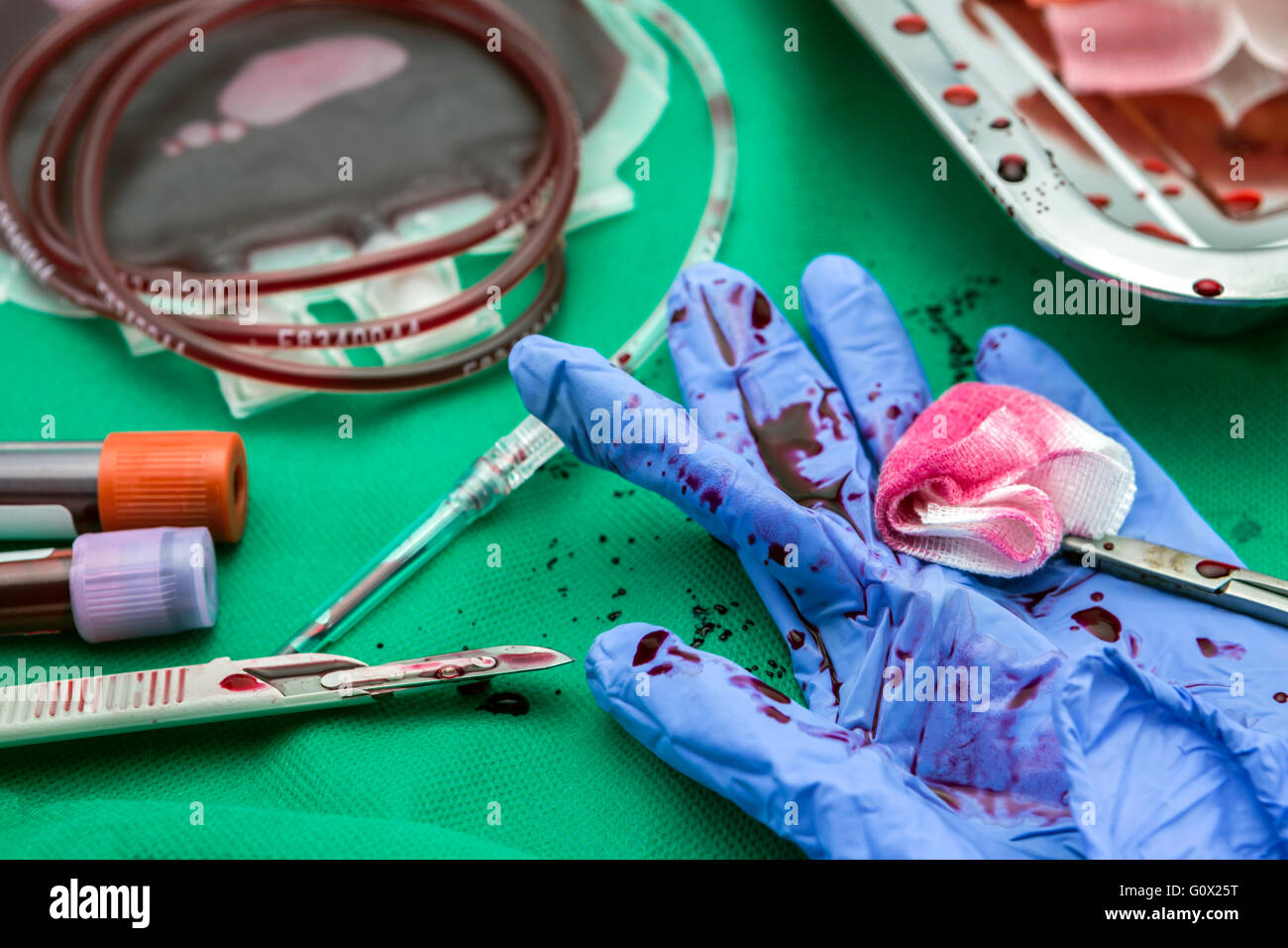Unit of concentrate of red blood cells, transplantation of upper limb
