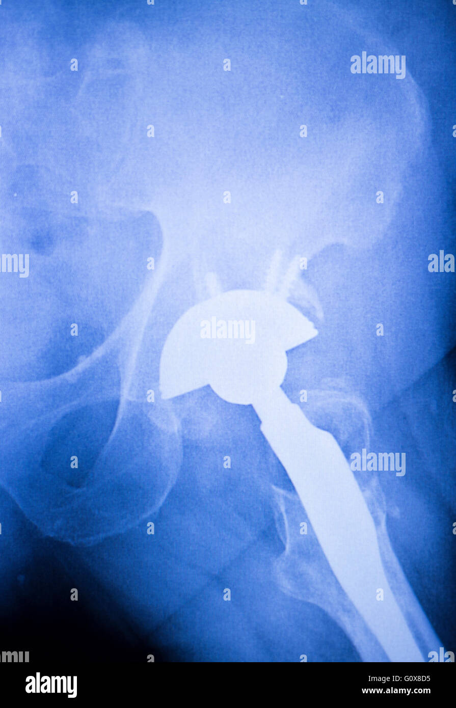 Hip joint implant xray scan test results for adult patient showing
