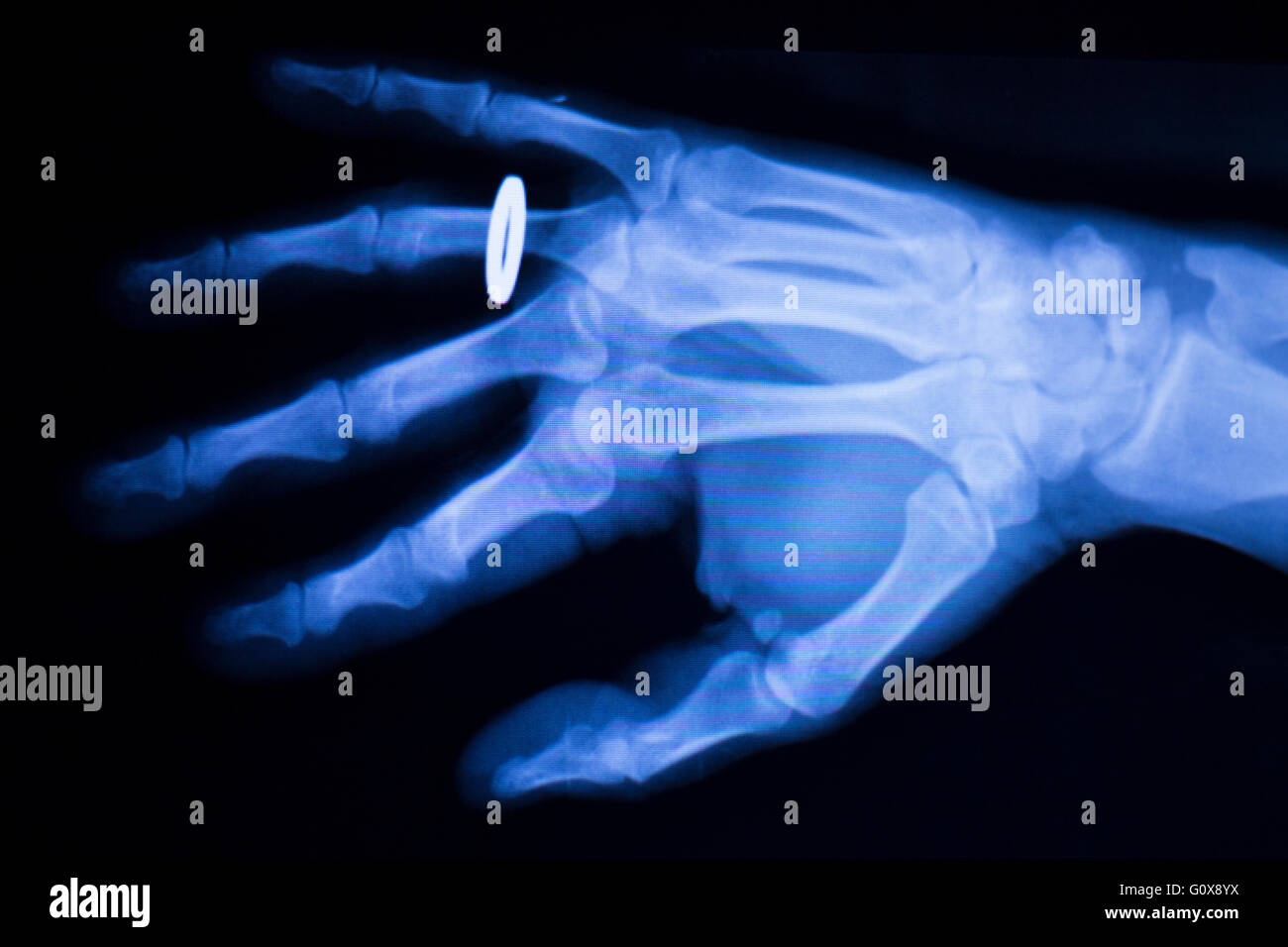 Hand x ray ring hires stock photography and images Alamy