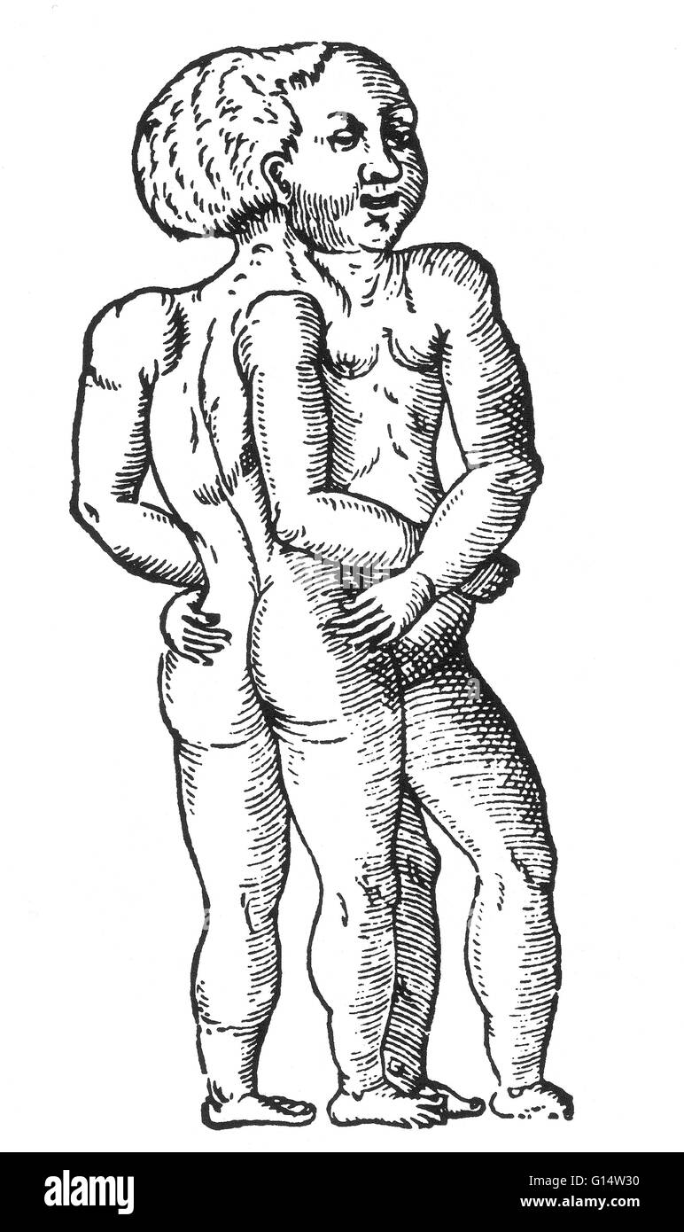 Woodcut of 'twins having only one head' from Des Monstres et prodiges by Ambroise Paré, 1573. Conjoined twins are identical twins born with their bodies joined at some point and having varying degrees of residual duplication, a result of the incomplete di Stock Photo