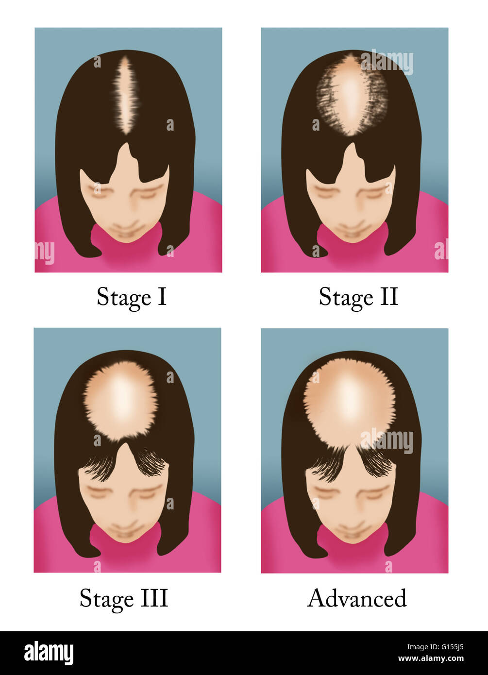 Hair Loss Does Taxol Chemo Cause Hair Loss Ludwig Hair Loss Scale