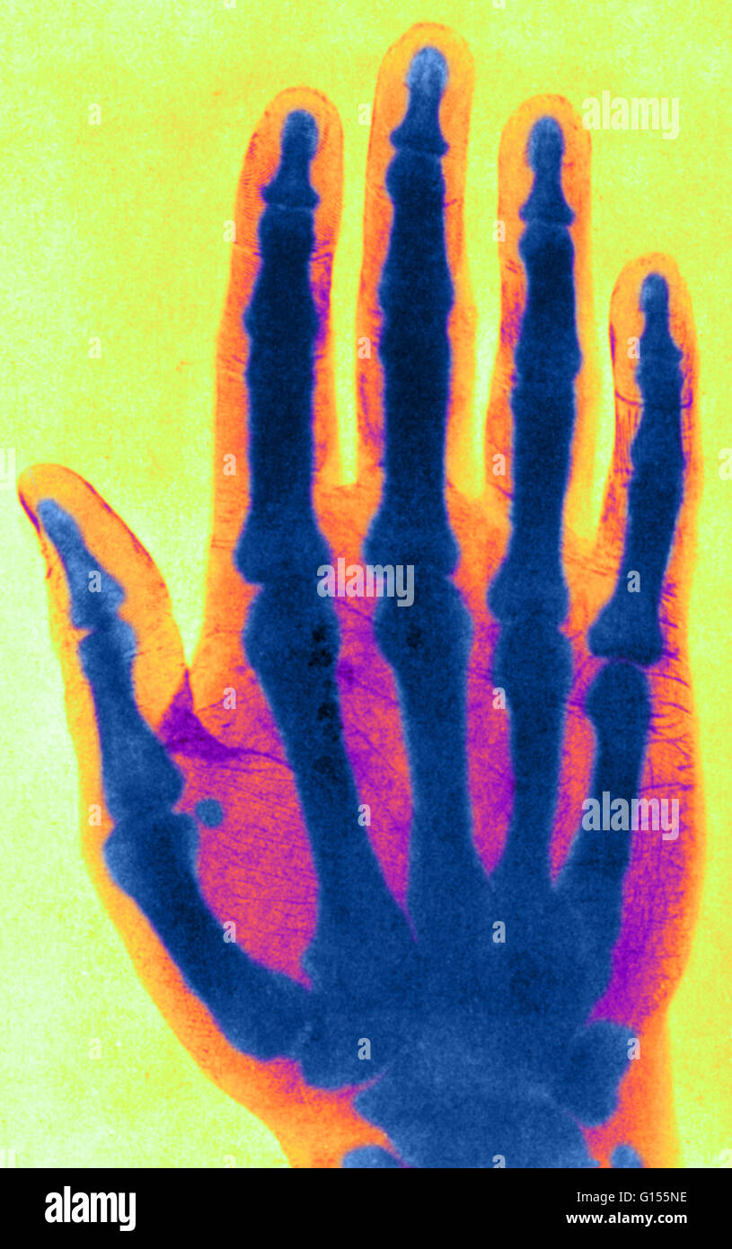 Color enhanced early x-ray. One of the clearest of the early class of radiographs was published by David Walsh, M.D. of London in his book "Roentgen Rays in Medical Work" of 1897. The fingerprints are clearly visible. Stock Photo