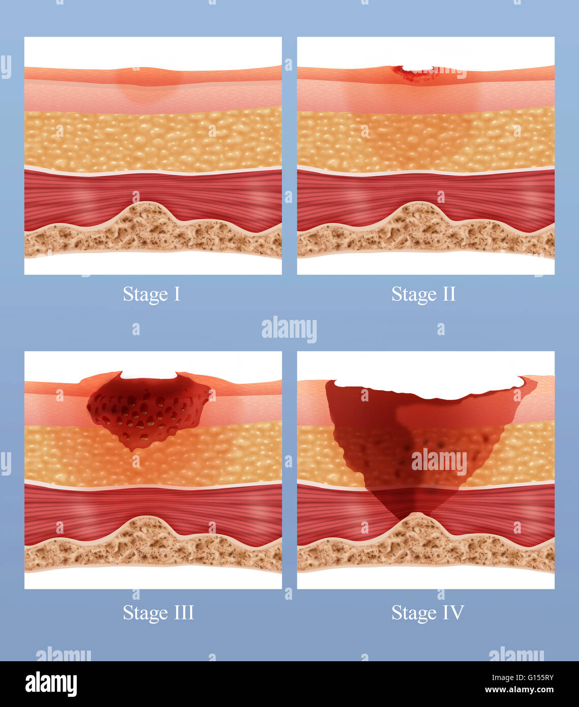 Illustration showing the stages of of a bed sore or pressure ulcer. Bed  sores can be caused by many factors including unrelieved pressure,  friction, humidity, etc. Bed sores usually afflict the frail