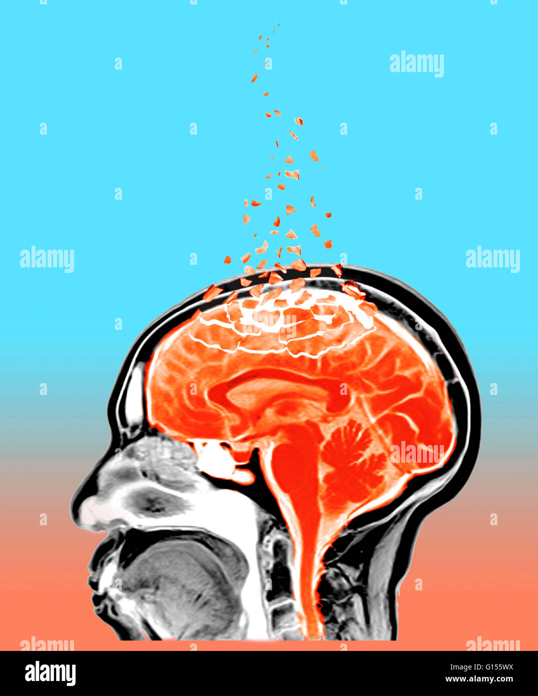 A conceptual illustration of a human brain affected by Alzheimer's ...
