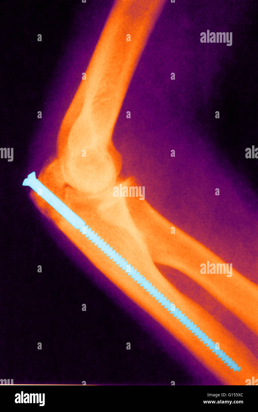 Color enhanced X-ray of a broken arm with a metal pin introduced into the marrow cavity in order to strengthen the bone. Wire may also be wound around the bone to assist it to set straight, and metal plates also may assist correct healing in the case of a Stock Photo