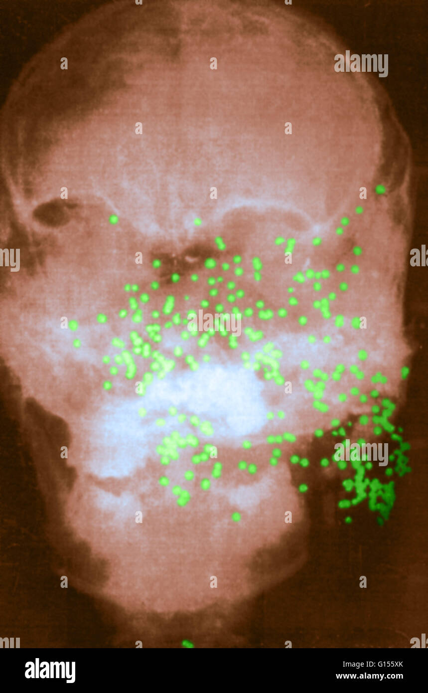 Color enhanced head x-ray of a murder victim showing groups of shotgun pellets across the face and jaw. Forensic pathology is a branch of medicine used for legal purposes and concerned with determining cause of death, examination of injuries due to crime Stock Photo