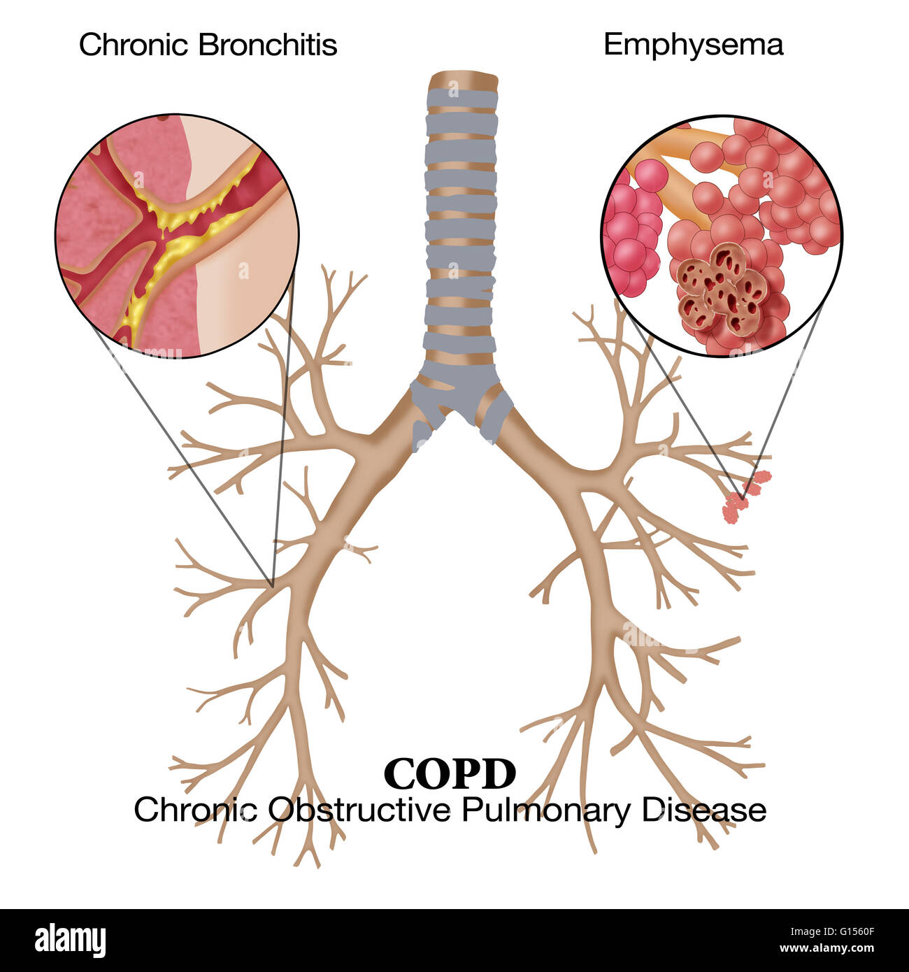 Illustration of chronic obstructive pulmonary disease (COPD), a Stock ...