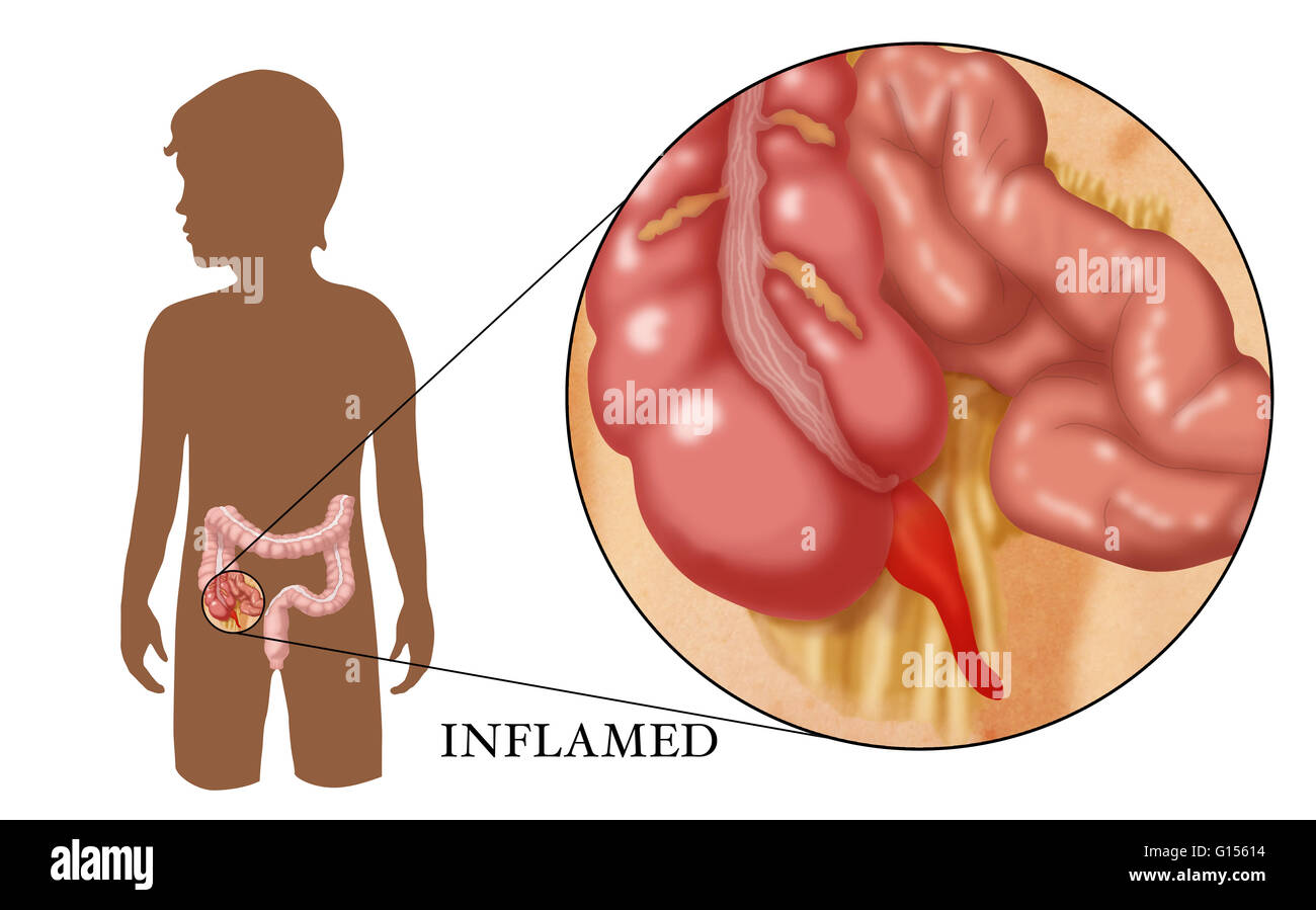 Illustration of an inflamed appendix Stock Photo Alamy
