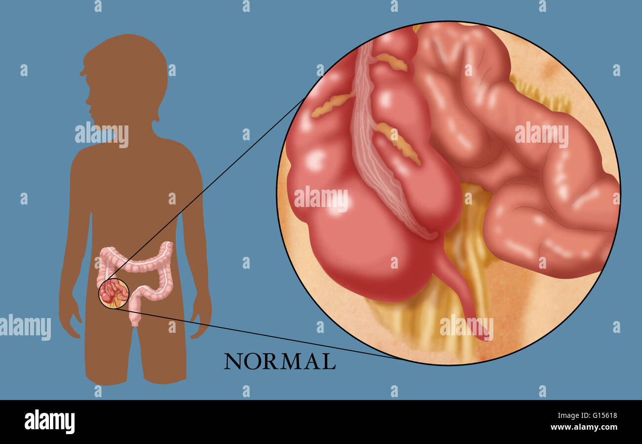 Illustration of a normal appendix Stock Photo - Alamy