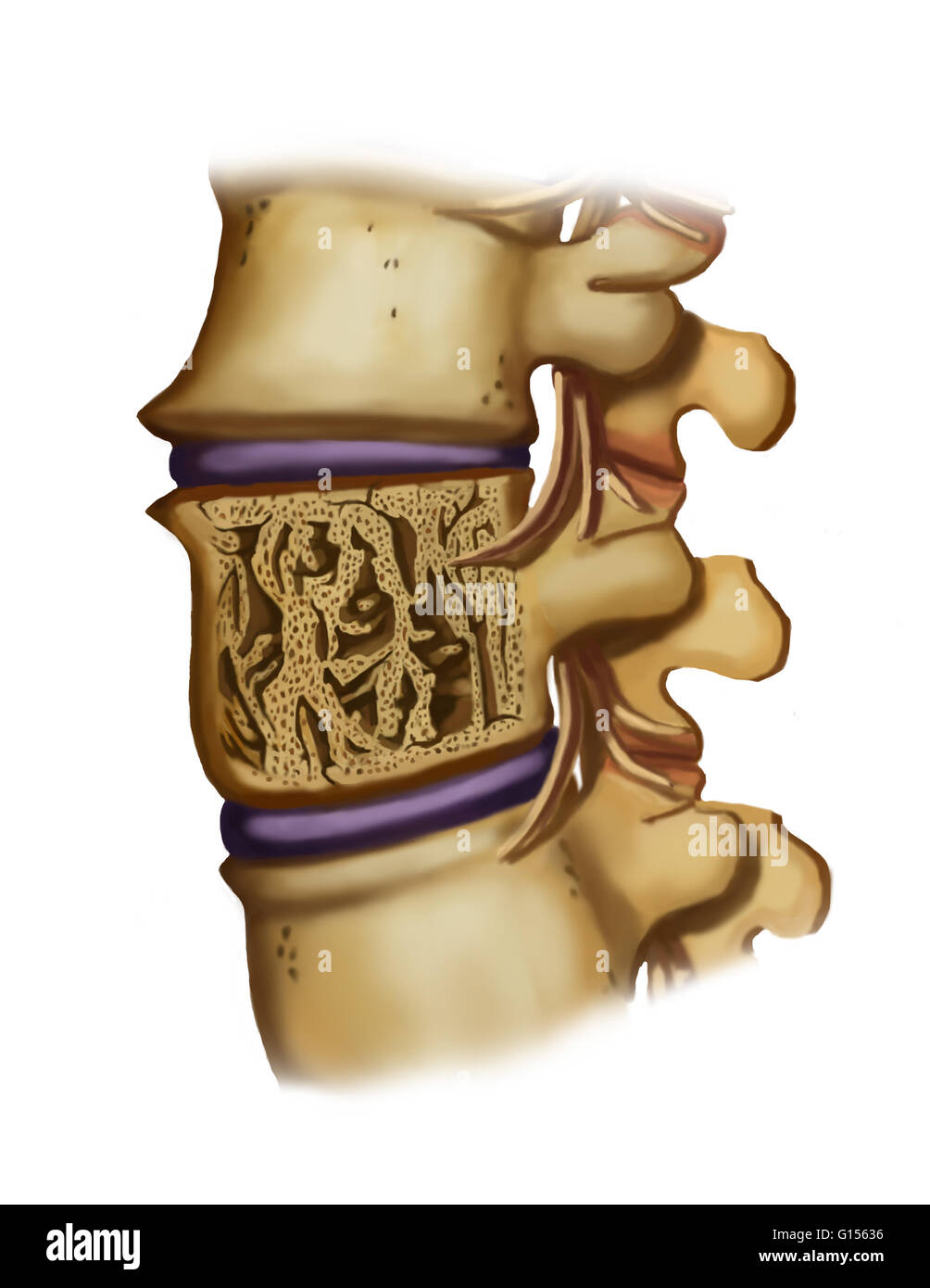 Artwork of a spine with fractured vertebrae due to osteoporosis. Osteoporosis is a lowering of bone density causing bones to become brittle and liable to fracture (as shown here). In this disease, spinal bones of the lower back more commonly fracture as t Stock Photo