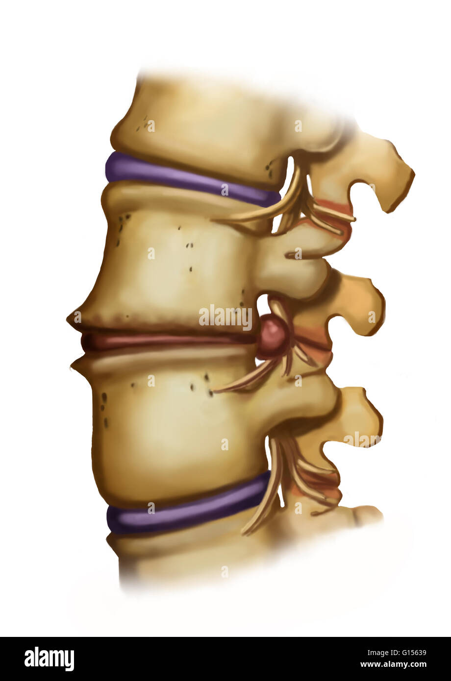 Illustration of spondylosis of the lumbar vertebrae (lumbar Stock Photo