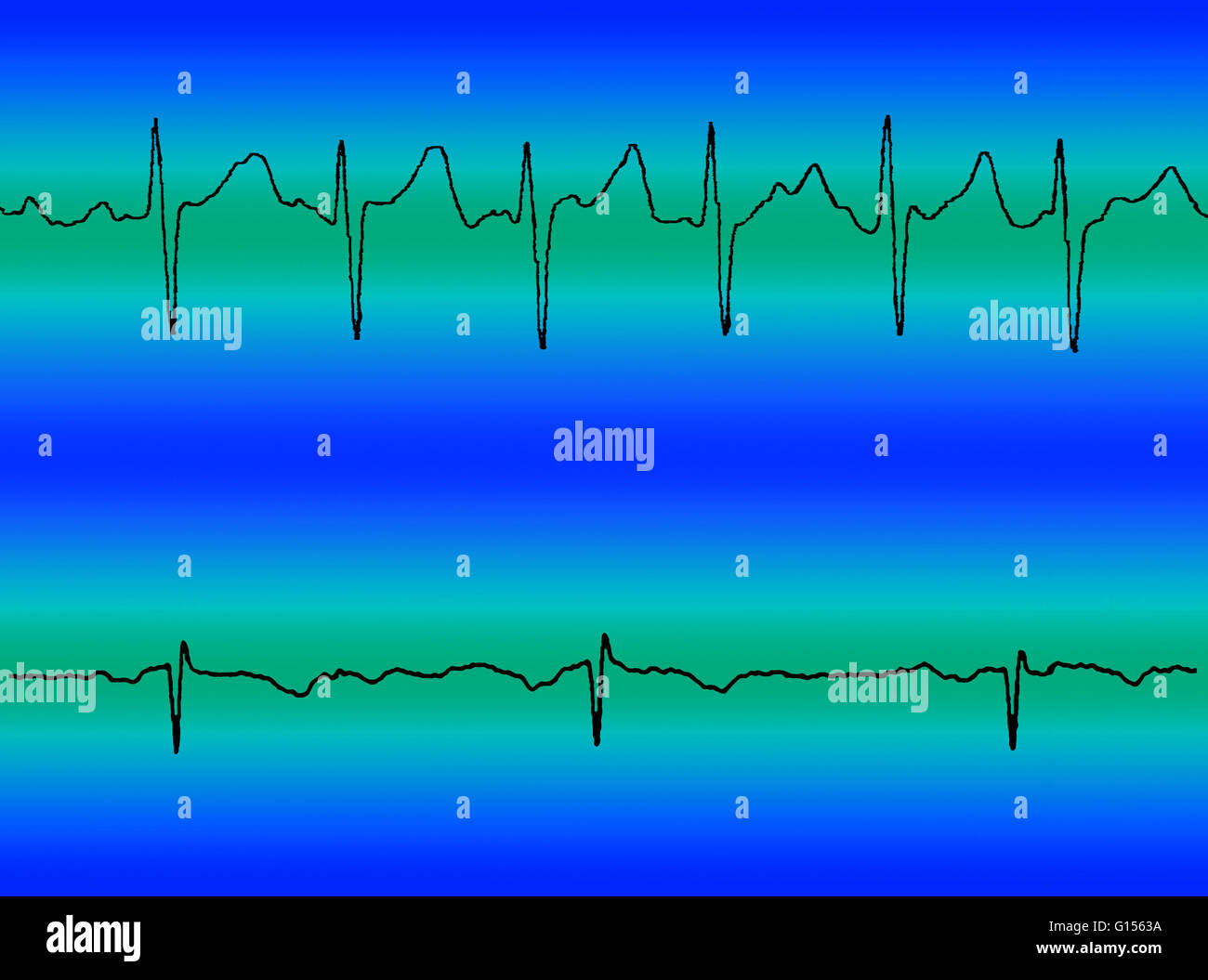 Composite image comparing an electrocardiogram (ECG) readout of atrial fibrillation (at top) and a normal heart beat (at bottom). Stock Photo