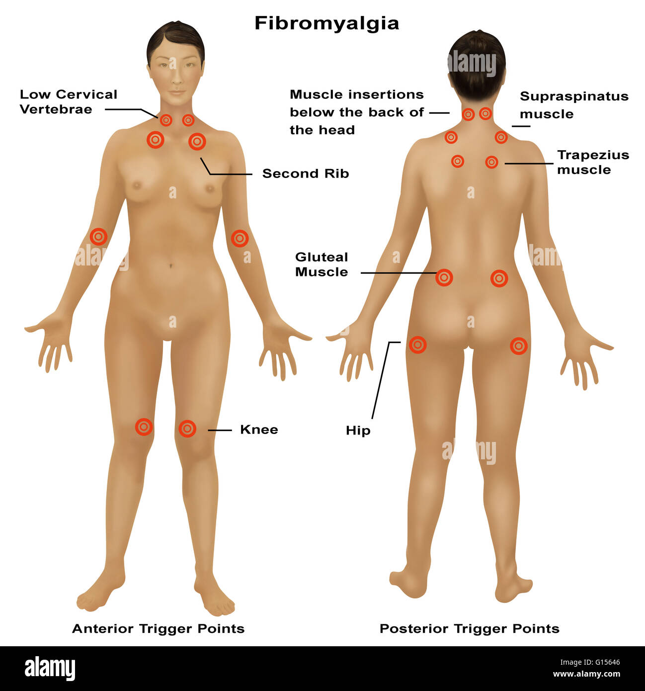 Musculoskeletal Pain Can Also Be Caused By Overuse In Hindi recommendations Musculoskeletal Pain Can Also Be Caused By Overuse In Hindi advise
