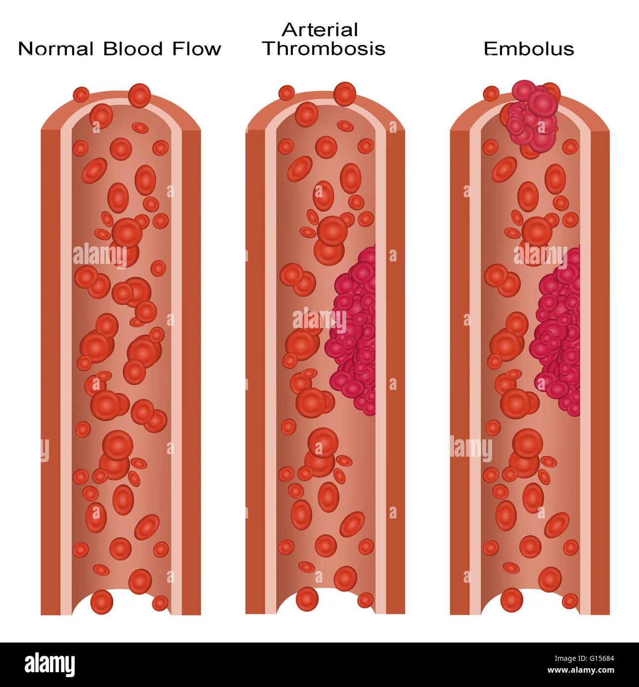 Illustration of a normal artery and ones with blood clots (arterial thrombosis and embolus).  An embolus is any detached, traveling intravascular mass carried by circulation, which is capable of clogging arterial capillary beds.  Arterial thrombosis is th Stock Photo