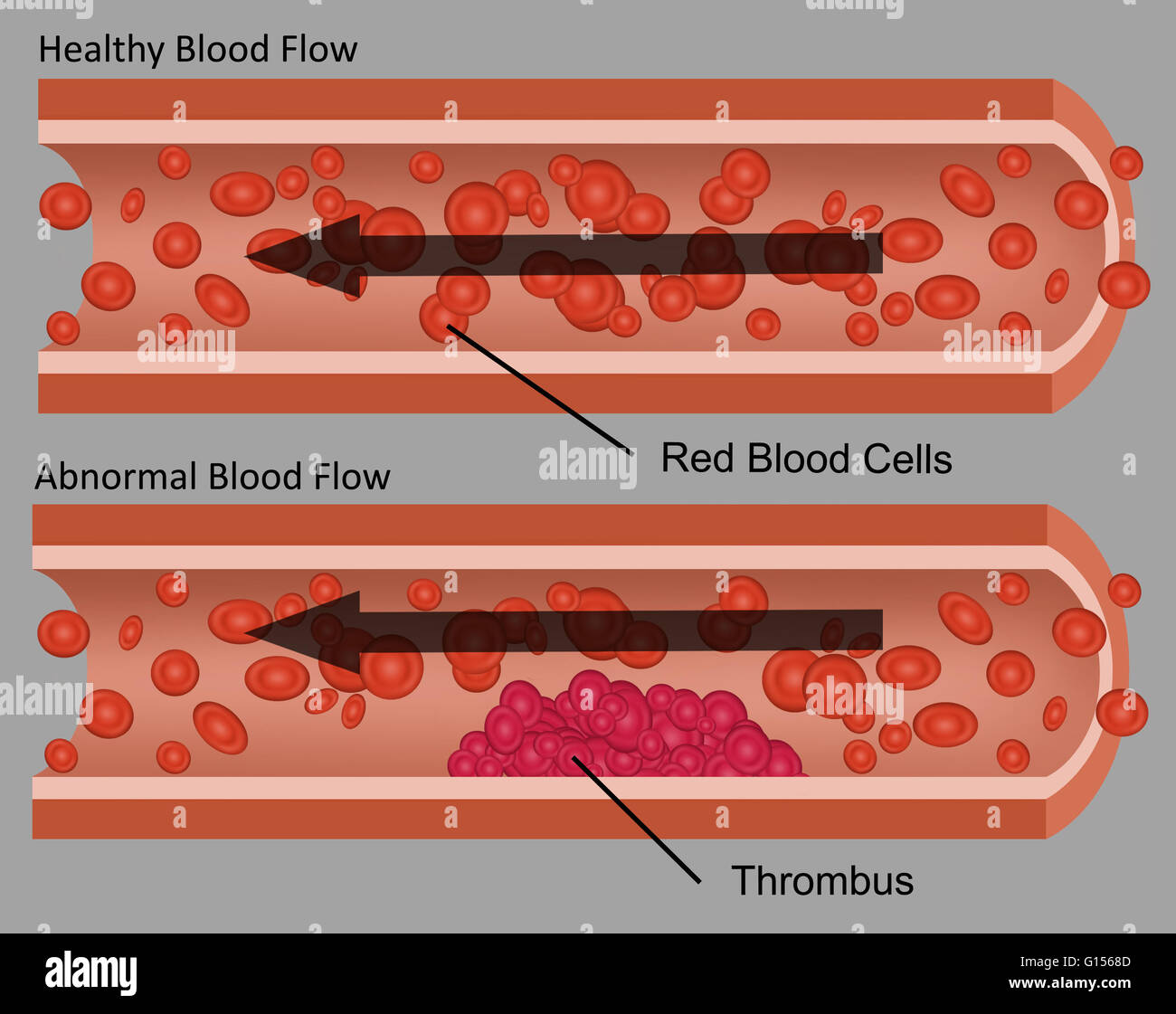 Illustrations showing healthy blood flow and abnormal blood flow (blood