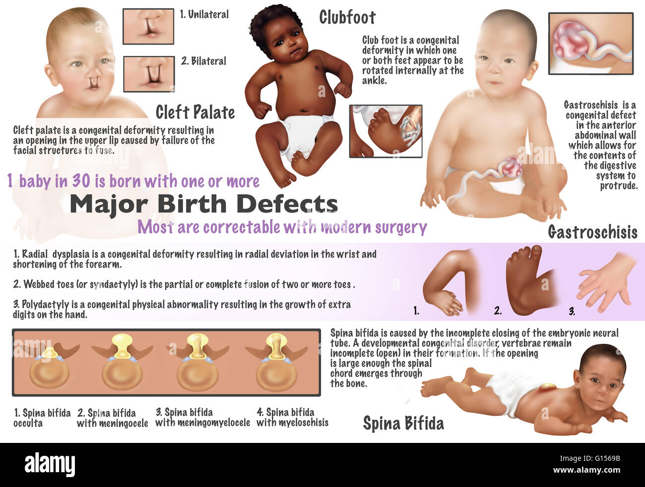 Illustration of birth defects found in babies. Cleft palate, clubfoot, radial dysplasia, webbed toes, polydactyl, gastroschisis, and spina bifida. 1 baby in 30 is born with one or more major birth defects. Most are correctable with modern surgery. Stock Photo