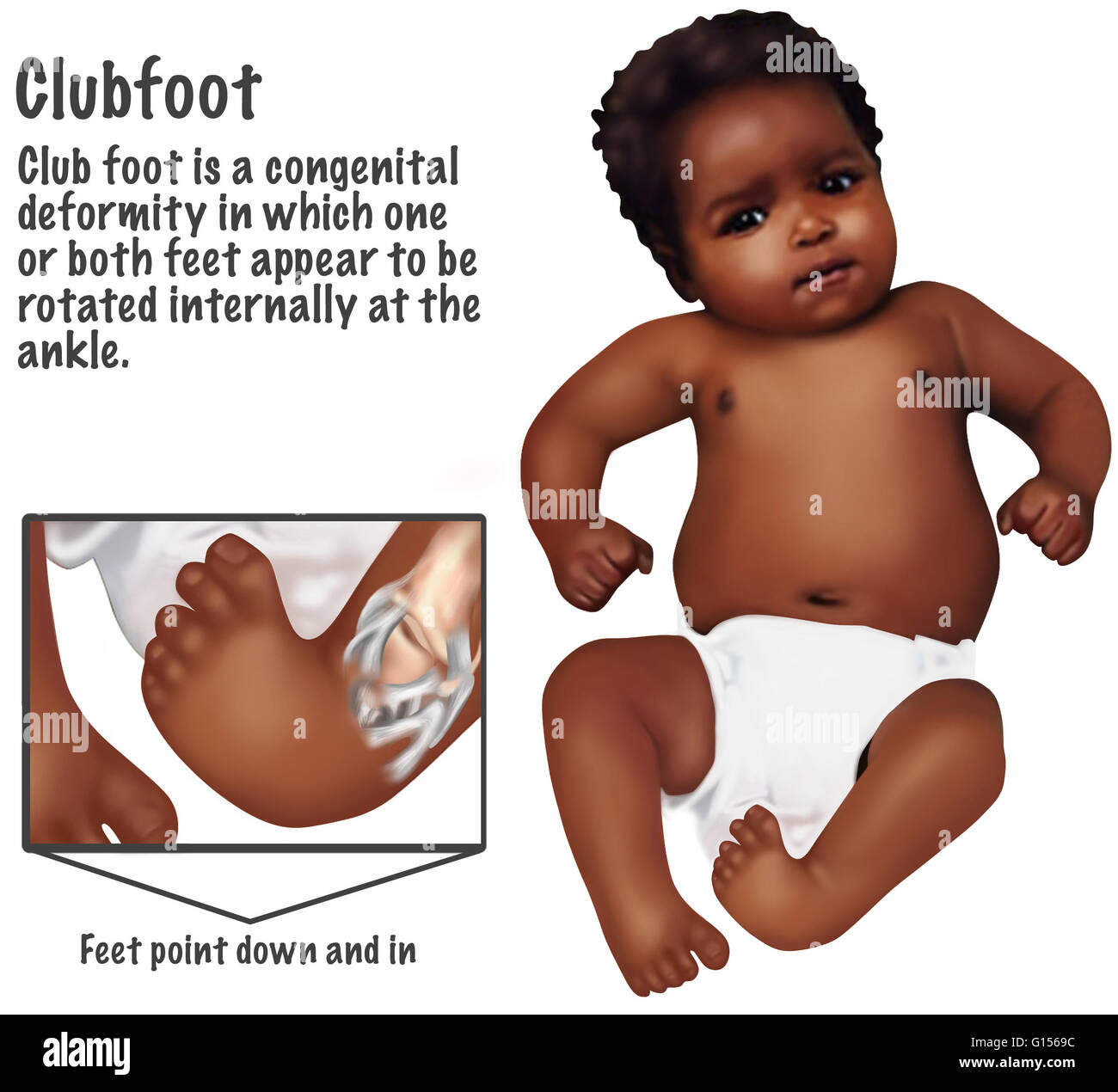 Illustration Of A Baby With A Club Foot Club Foot Or Club Feet Is A Congenital Deformity Which One Or Both Feet Appear To Be Rotated Internally At The Ankle It Is