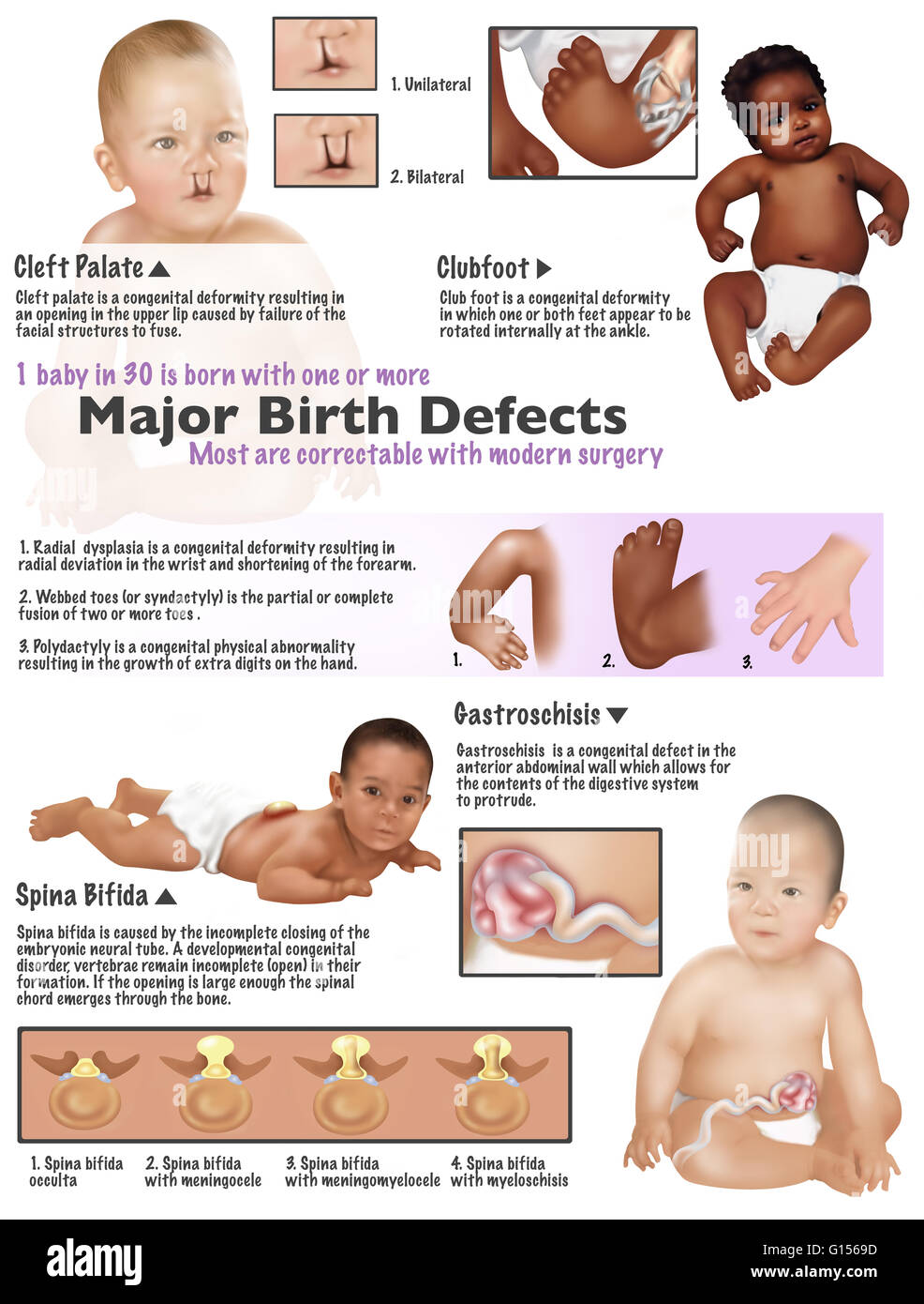 Illustration of birth defects found in babies. Cleft palate, clubfoot, radial dysplasia, webbed toes, polydactyl, gastroschisis, and spina bifida. 1 baby in 30 is born with one or more major birth defects. Most are correctable with modern surgery. Stock Photo