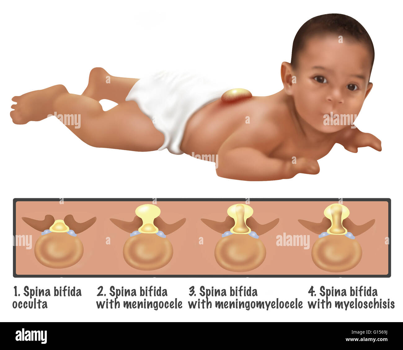 An illustration of a baby with Spina Bifida. Spina bifida is caused by the incomplete closing of the embryonic neutral tube. A development congenital disorder, vertebrae remain incomplete (open) in their formation. If the opening is large enough the spina Stock Photo
