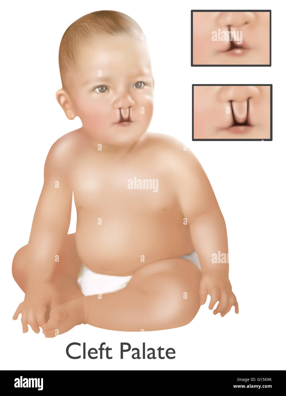 An illustration of a baby with a cleft palate. A cleft palate is a congenial deformity resulting in an opening in the upper lip by failure of the facial structures to fuse. The cleft palate opening can be a one sided unilateral or two sided bilateral. 1 b Stock Photo