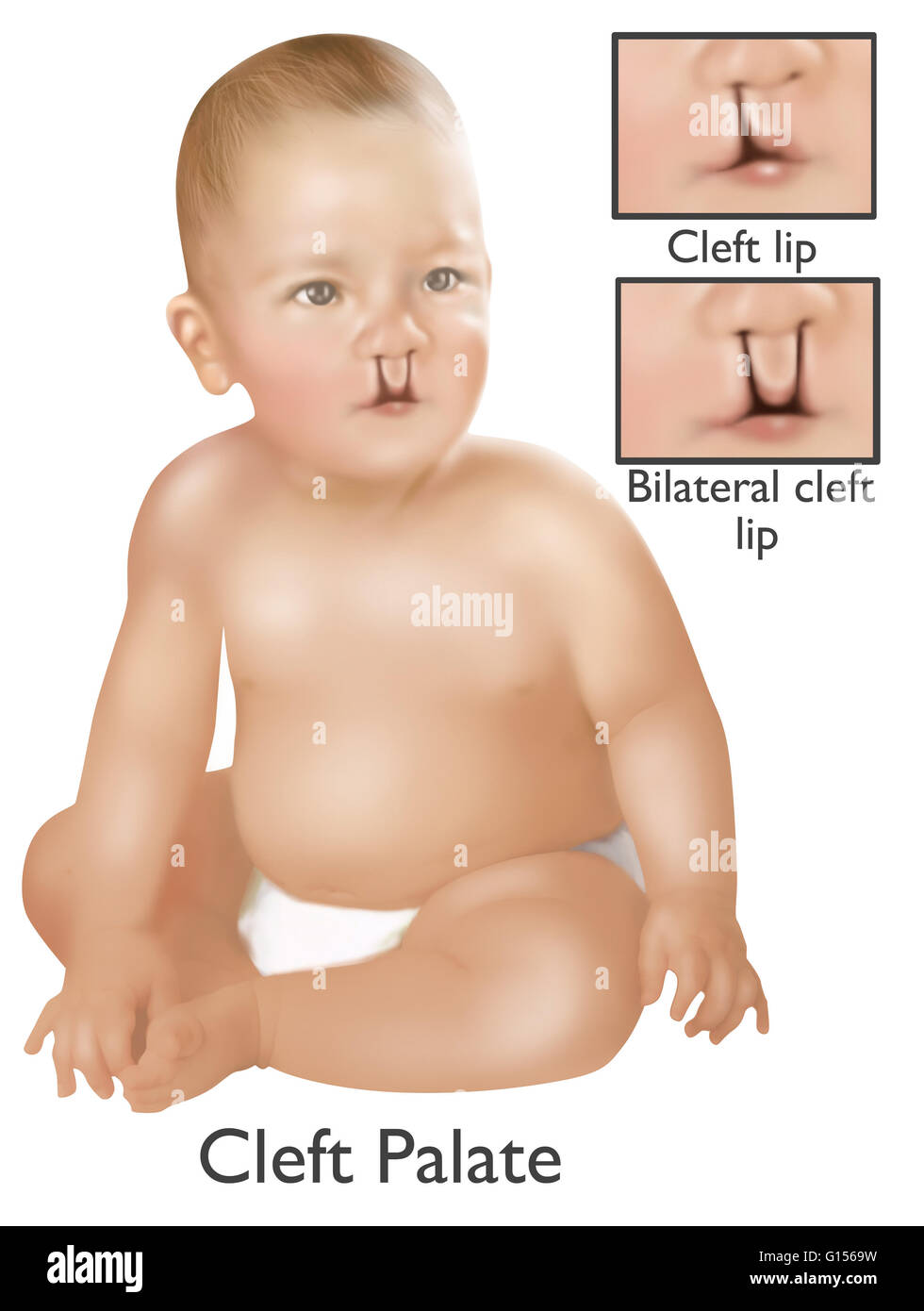 An illustration of a baby with a cleft palate. A cleft palate is a congenial deformity resulting in an opening in the upper lip by failure of the facial structures to fuse. The cleft palate opening can be a one sided unilateral or two sided bilateral. 1 b Stock Photo