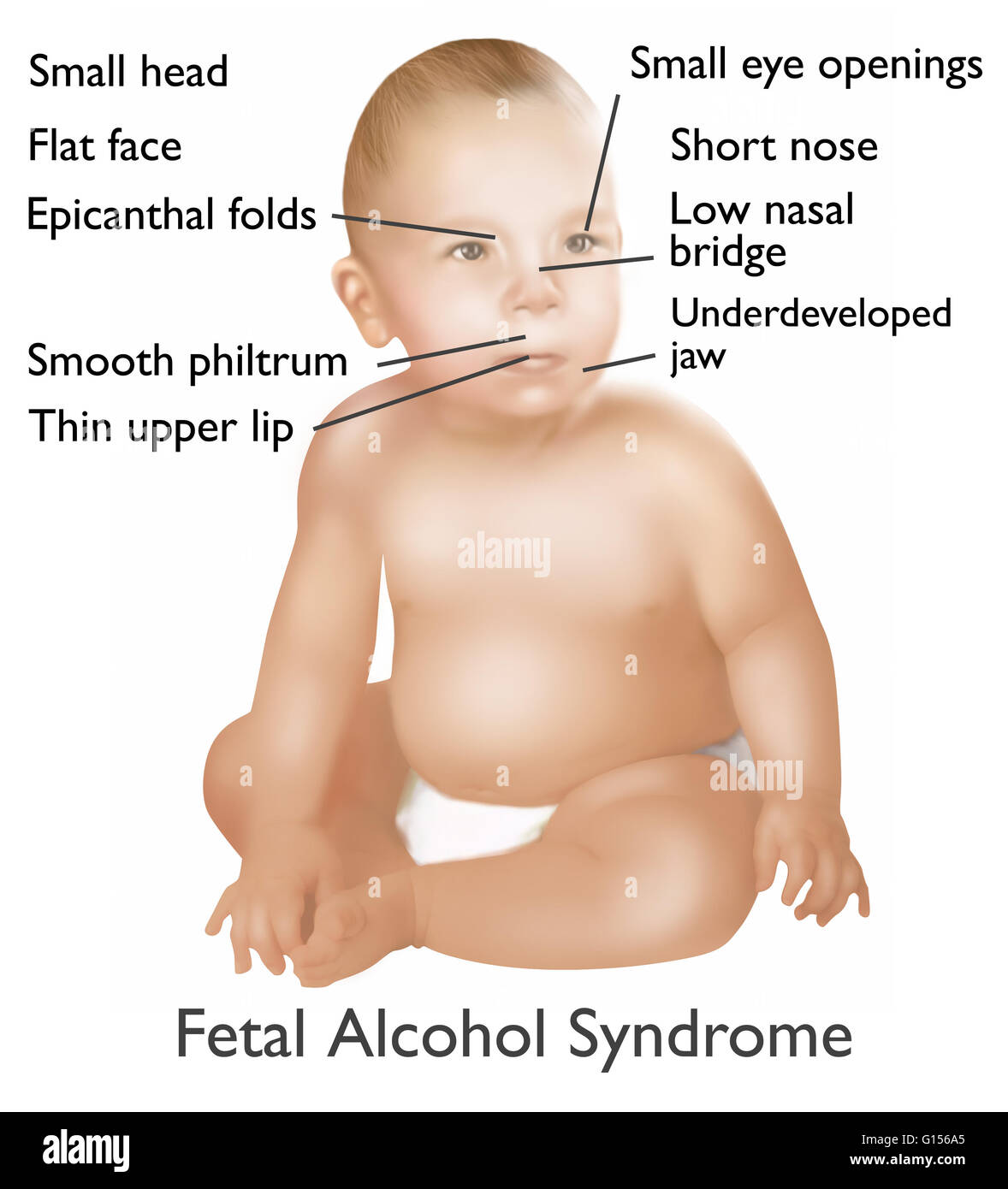 Illustration of baby with Fetal Alcohol Syndrome. Fetal Alcohol Syndrome or (FAS) is a condition in infants that is caused by alcohol consumption by the mother during time of pregnancy. Mental and physical defects such as a small head, flat face, epicanth Stock Photo