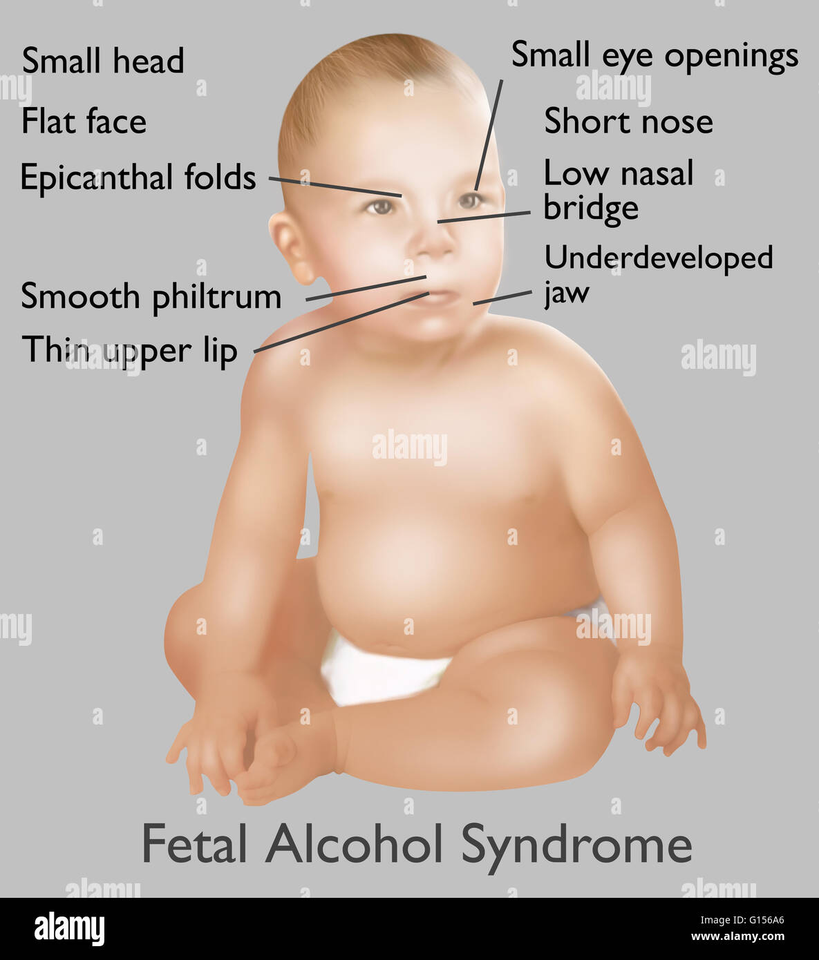 Illustration of baby with Fetal Alcohol Syndrome. Fetal Alcohol Syndrome or (FAS) is a condition in infants that is caused by alcohol consumption by the mother during time of pregnancy. Mental and physical defects such as a small head, flat face, epicanth Stock Photo