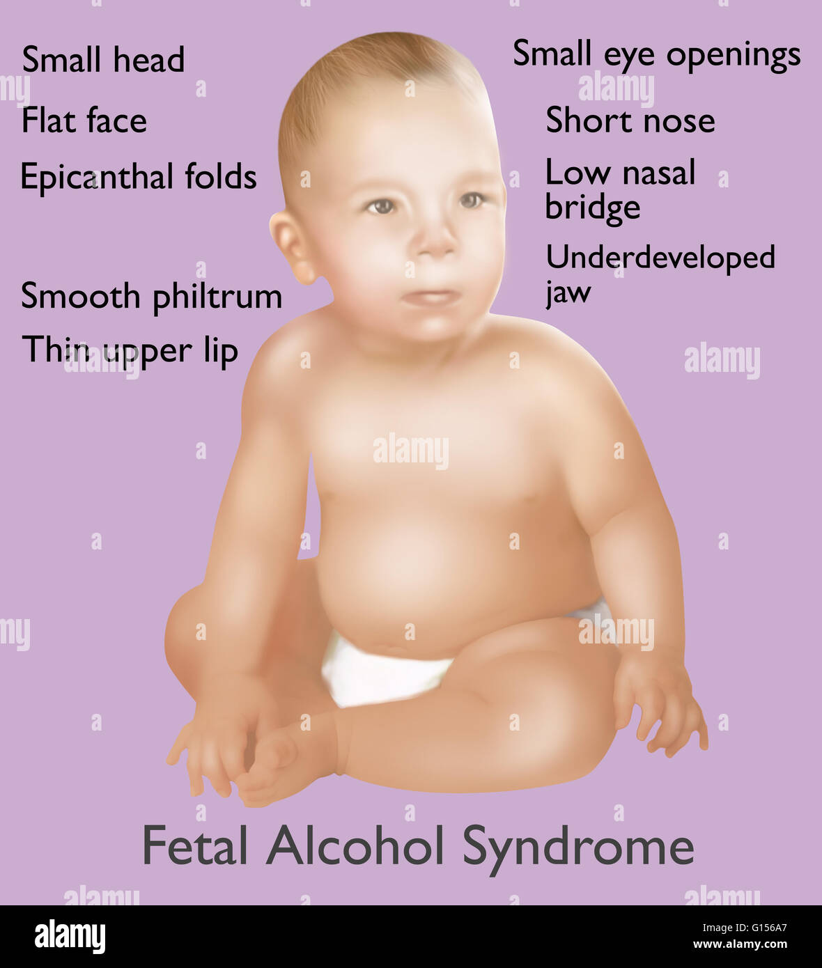 Illustration of baby with Fetal Alcohol Syndrome. Fetal Alcohol Syndrome or (FAS) is a condition in infants that is caused by alcohol consumption by the mother during time of pregnancy. Mental and physical defects such as a small head, flat face, epicanth Stock Photo