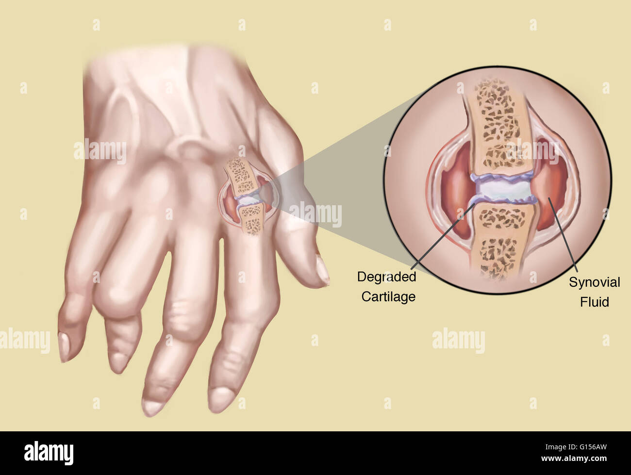 An illustration showing the degraded cartilage and synovial fluid in