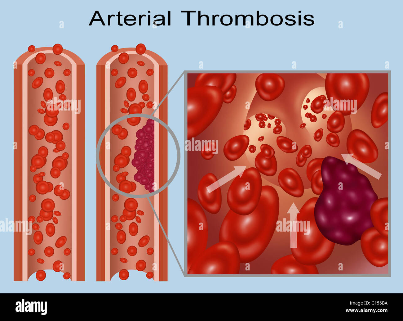 Illustration comparing a normal artery (left) and one with a blood clot