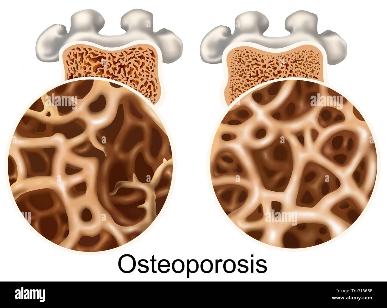Illustration comparing a normal and osteoporotic bone. The osteoporotic