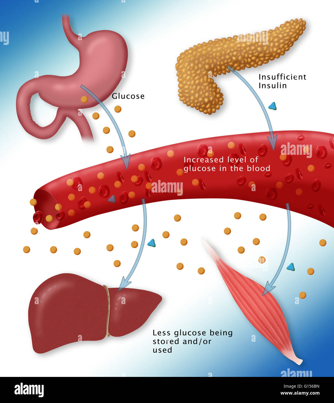 Illustration of Type I Diabetes, defined by the insufficient production ...