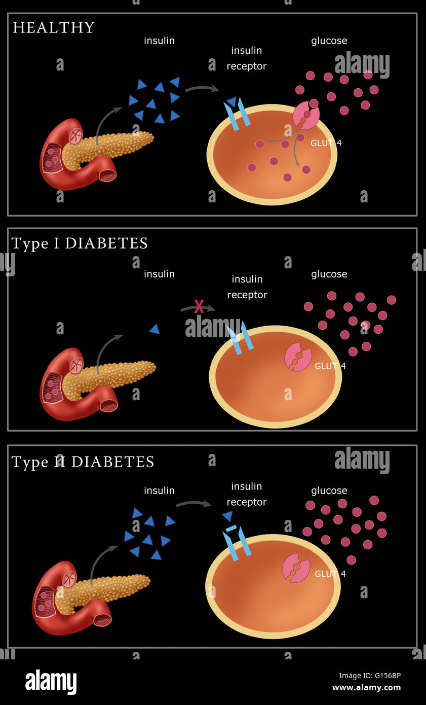 Illustration comparing a healthy glucose and insulin production (top